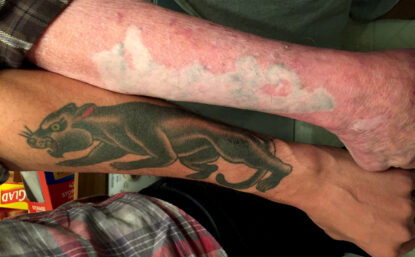 Photograph of the arms of two men. One has a panther tattoo and the other has a scar in the shape of an animal. It looks like a tattoo that has been removed.